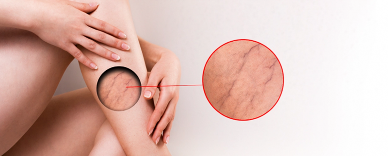 Ретикулярный варикоз