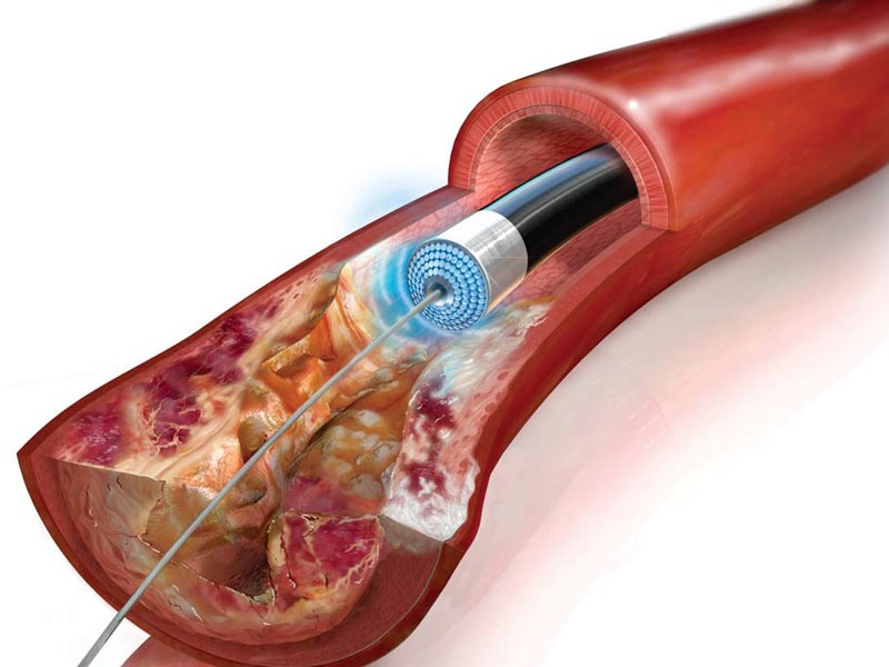 Реканализация вен