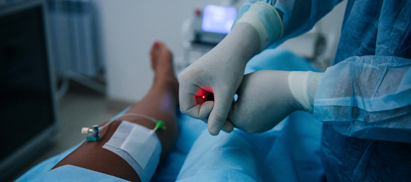 Лазерная коагуляция вен