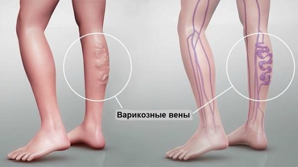 Варикозные вены