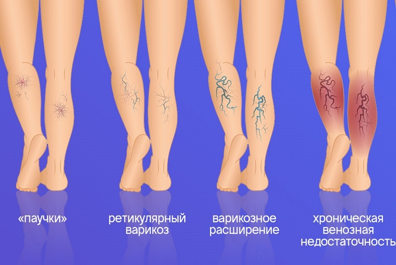 Стадии варикоза