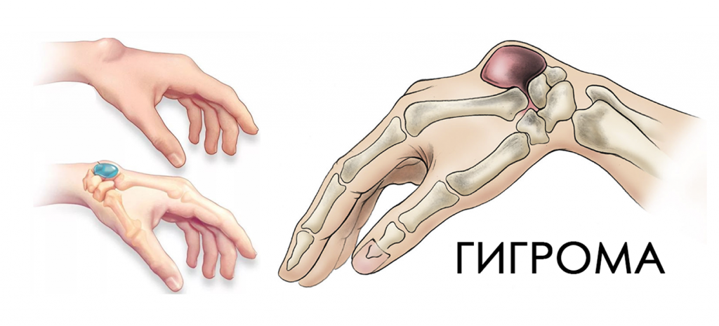 Гигрома