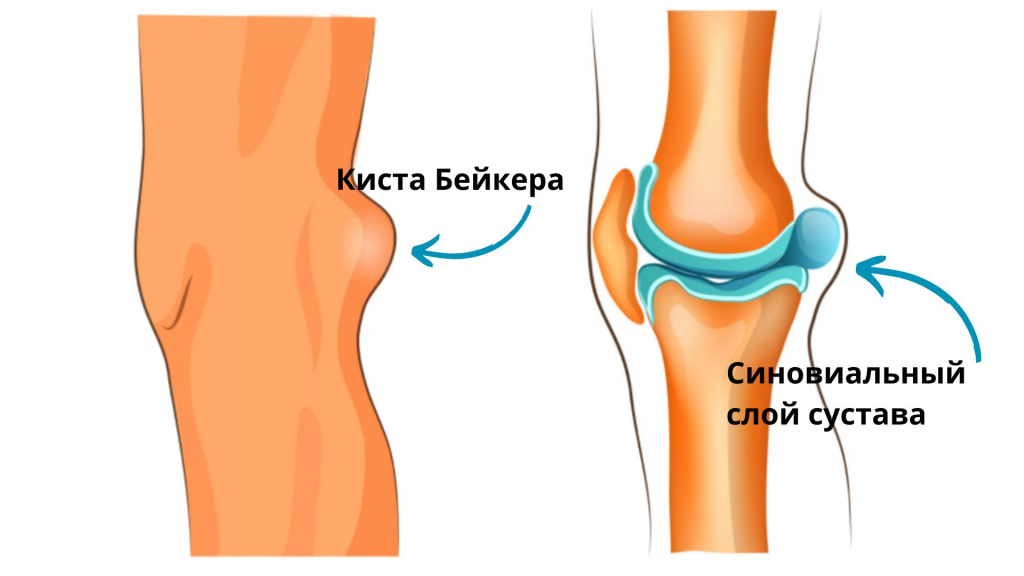 Киста Бейкера