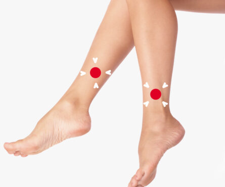 Трофическая язва на ноге: почему она не заживает и как мы это исправляем