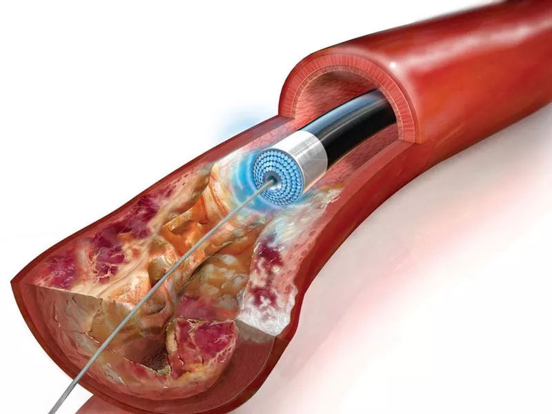 Реканализация вен